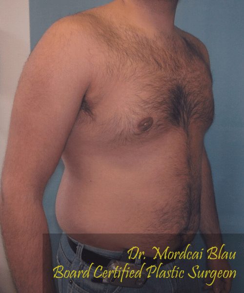 Pseudogynecomastia