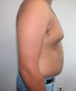 Pseudogynecomastia