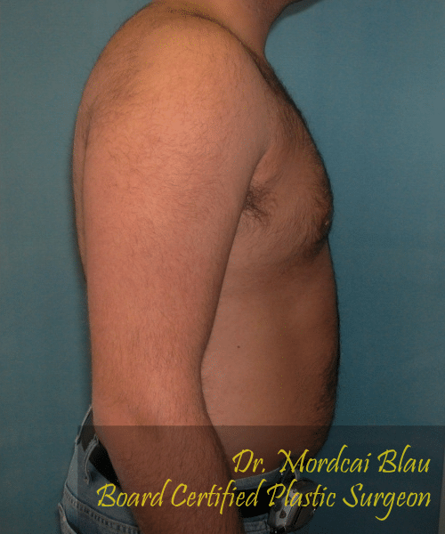 Pseudogynecomastia