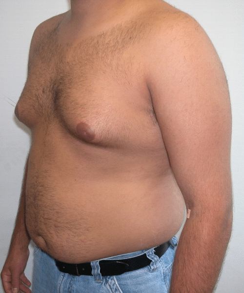 Pseudogynecomastia