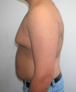 Pseudogynecomastia