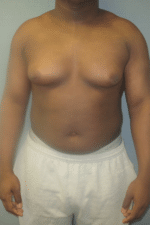 Severe Gynecomastia