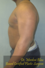 Severe Gynecomastia