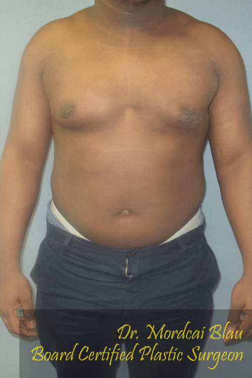 Severe Gynecomastia