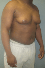 Severe Gynecomastia