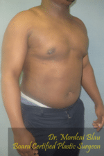 Severe Gynecomastia