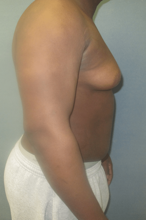 Severe Gynecomastia