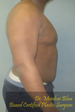 Severe Gynecomastia