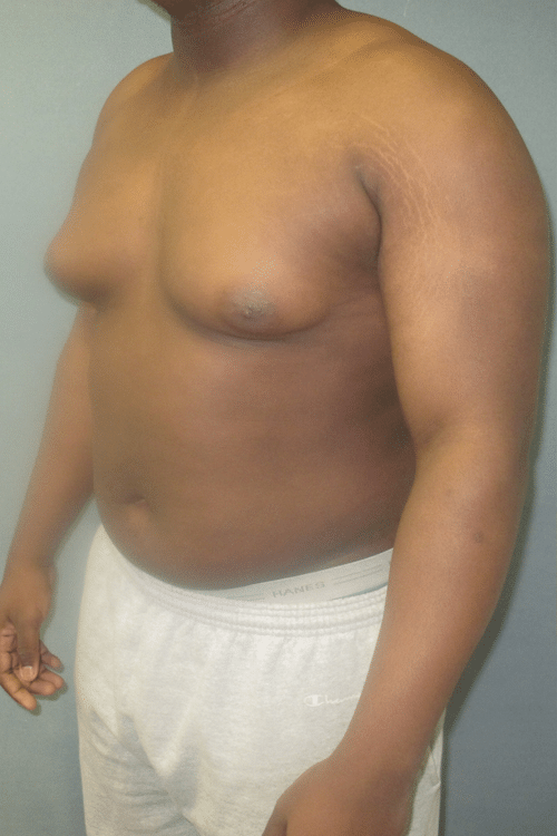 Severe Gynecomastia