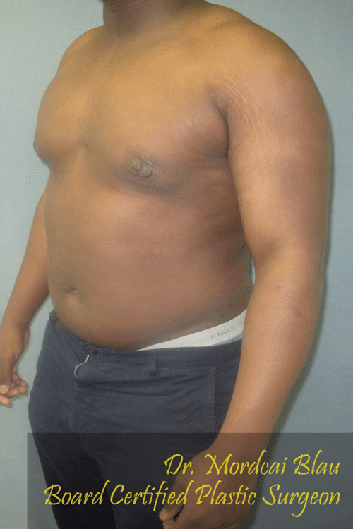 Severe Gynecomastia