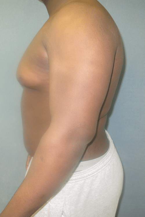 Severe Gynecomastia