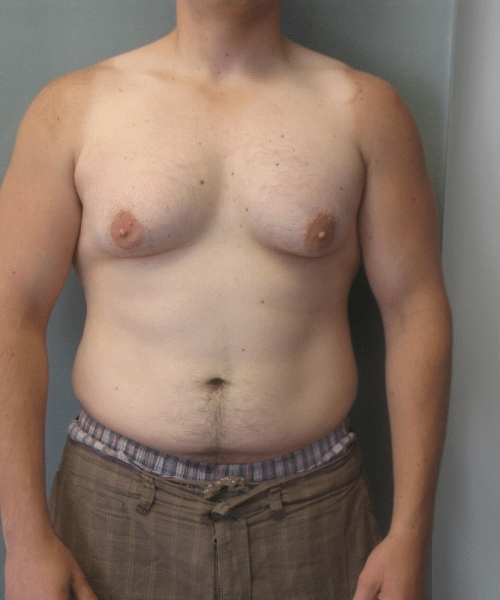 Severe Gynecomastia