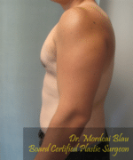 Severe Gynecomastia