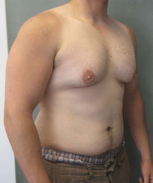 Severe Gynecomastia