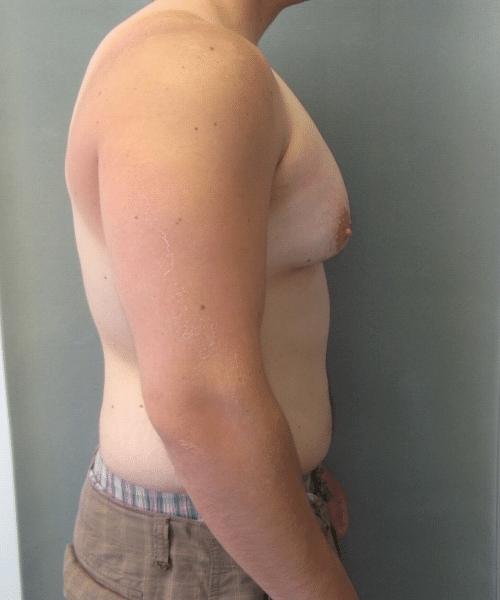 Severe Gynecomastia