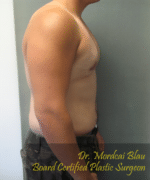 Severe Gynecomastia