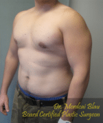 Severe Gynecomastia