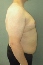 Severe Gynecomastia