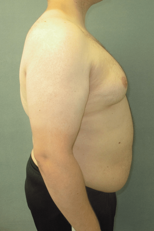 Severe Gynecomastia