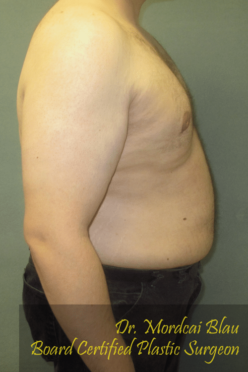 Severe Gynecomastia