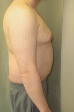 Severe Gynecomastia