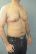 Severe Gynecomastia