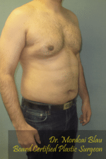 Severe Gynecomastia