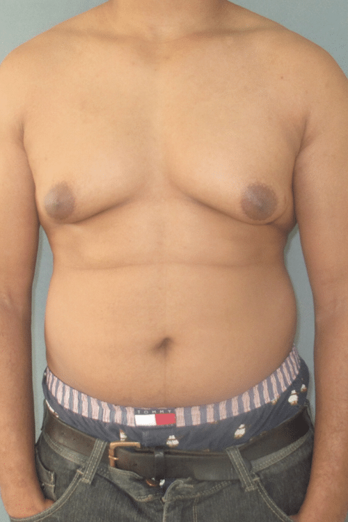 Severe Gynecomastia