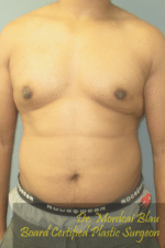 Severe Gynecomastia