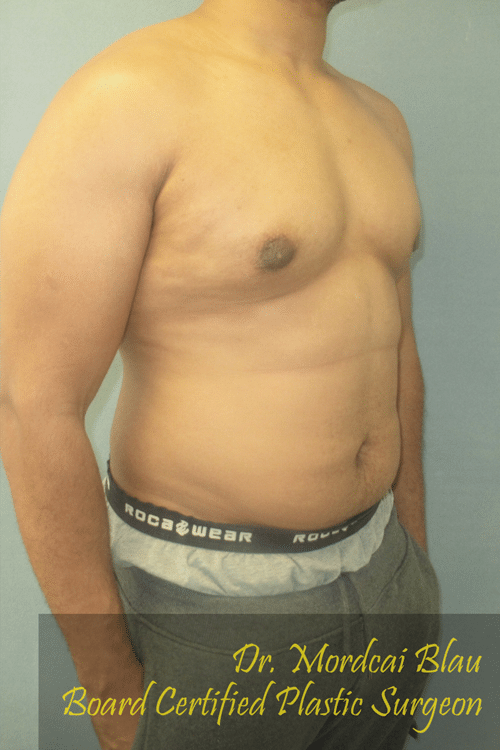 Severe Gynecomastia