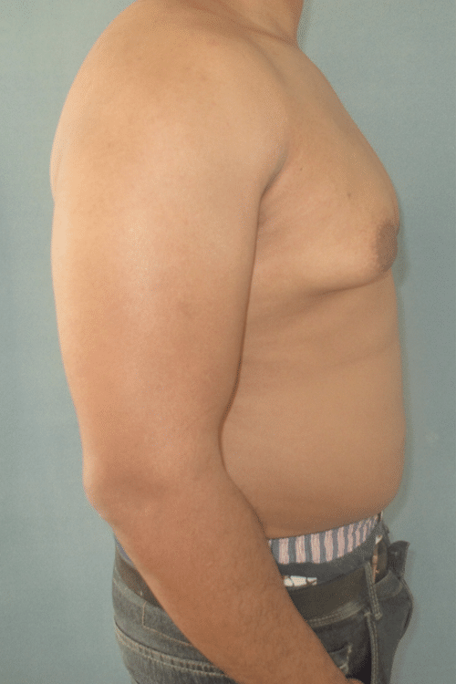 Severe Gynecomastia