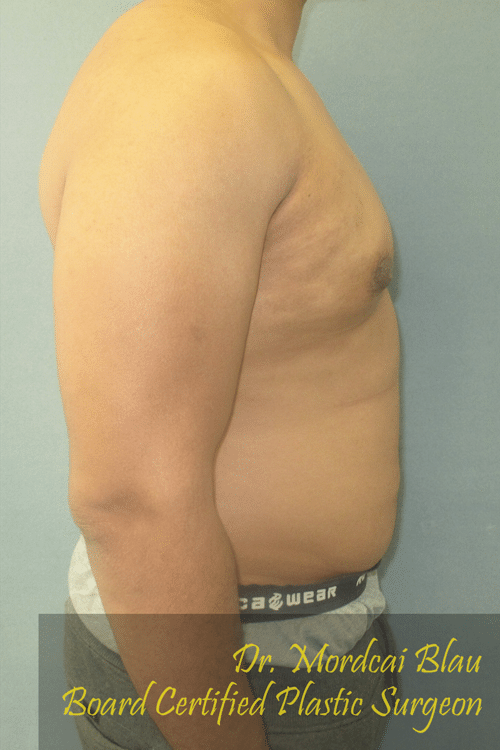 Severe Gynecomastia