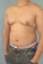 Severe Gynecomastia