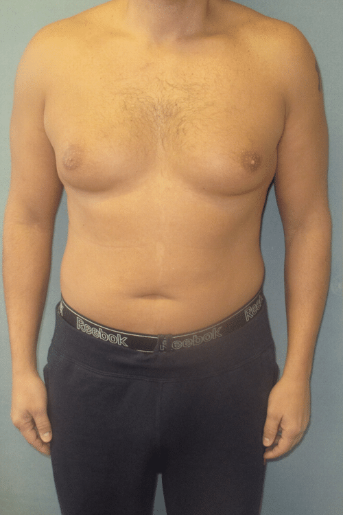 Severe Gynecomastia