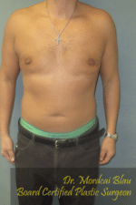 Severe Gynecomastia