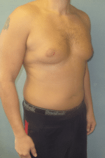 Severe Gynecomastia