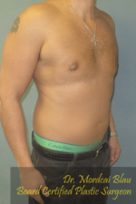 Severe Gynecomastia