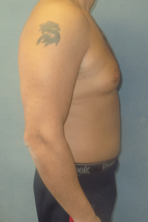 Severe Gynecomastia