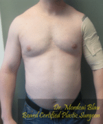 Severe Gynecomastia