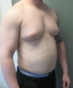 Severe Gynecomastia