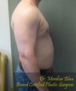 Severe Gynecomastia