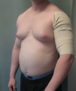 Severe Gynecomastia