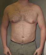 Severe Gynecomastia