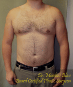 Severe Gynecomastia