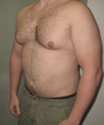 Severe Gynecomastia