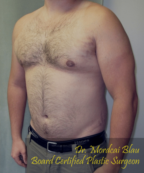 Severe Gynecomastia