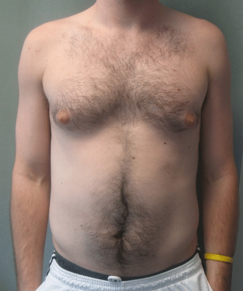 Severe Gynecomastia