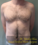 Severe Gynecomastia