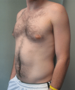 Severe Gynecomastia