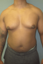 Severe Gynecomastia